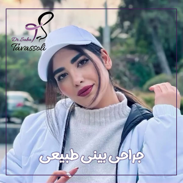 جراحی بینی طبیعی در بابل + دکتر صبا توسلی