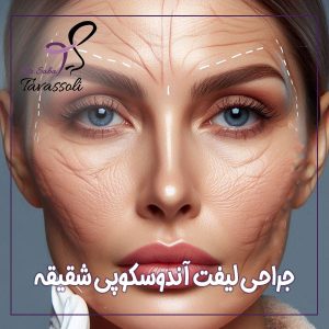 جراحی لیفت آندوسکوپی شقیقه+ دکتر صبا توسلی