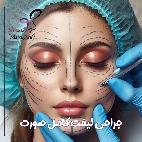 جراحی لیفت کامل صورت + دکتر صبا توسلی