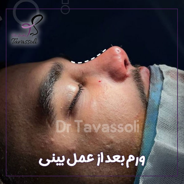 ورم بعد از عمل بینی + دکتر صبا توسلی