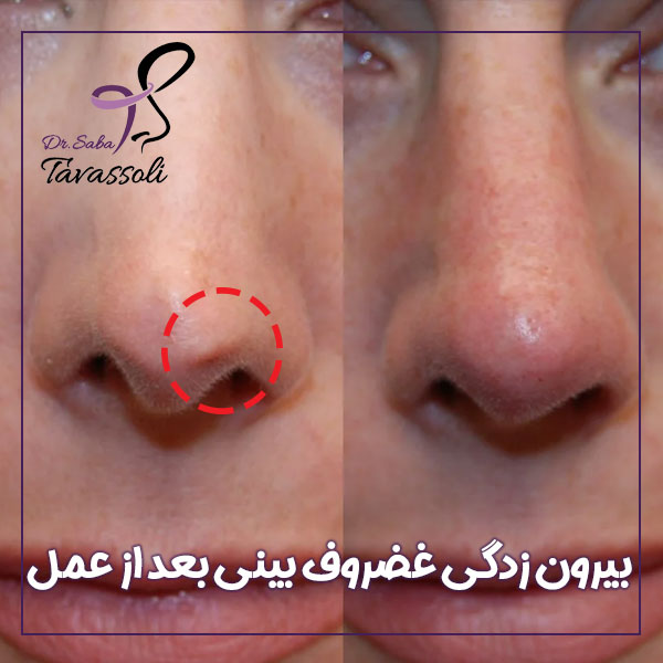 بیرون ‌زدگی غضروف بینی بعد از عمل + دکتر صبا توسلی