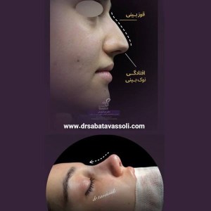 Rhinoplasty-10