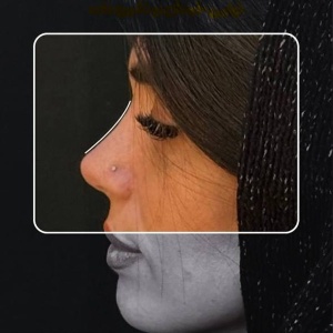 Rhinoplasty-12