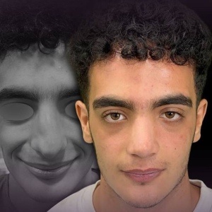 Rhinoplasty-13
