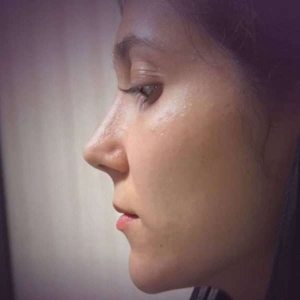 Rhinoplasty-19