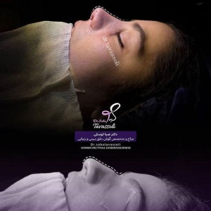 Rhinoplasty-20