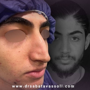 Rhinoplasty-23