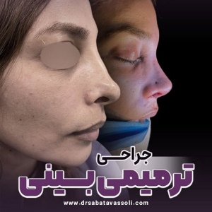 Rhinoplasty-25