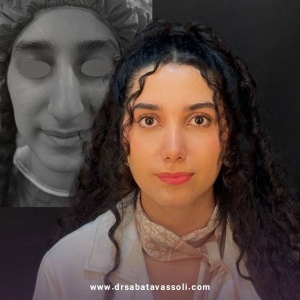 Rhinoplasty-26