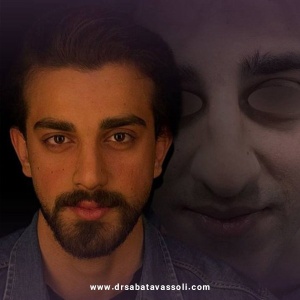 Rhinoplasty-27
