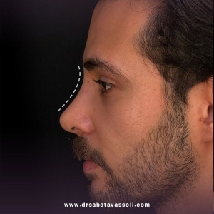 Rhinoplasty-30
