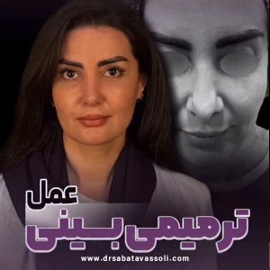 Rhinoplasty-31