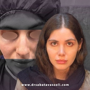 Rhinoplasty-34