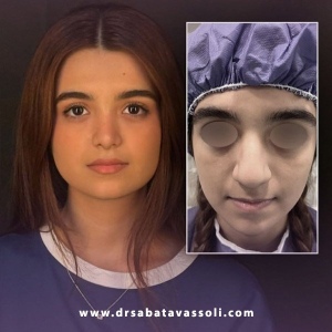 Rhinoplasty-35