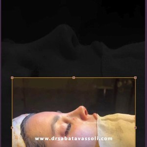 Rhinoplasty-36