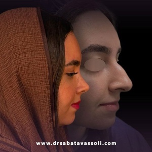 Rhinoplasty-37