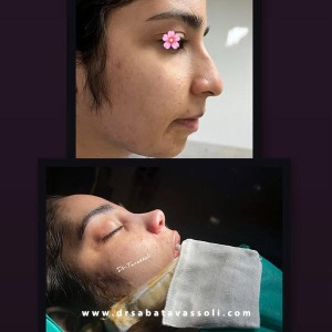 Rhinoplasty-38