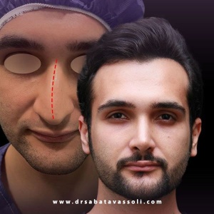 Rhinoplasty-39