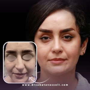 Rhinoplasty-40