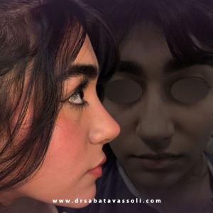 Rhinoplasty-42