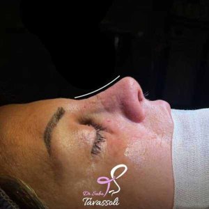 Rhinoplasty-7