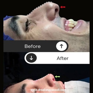 Rhinoplasty-8