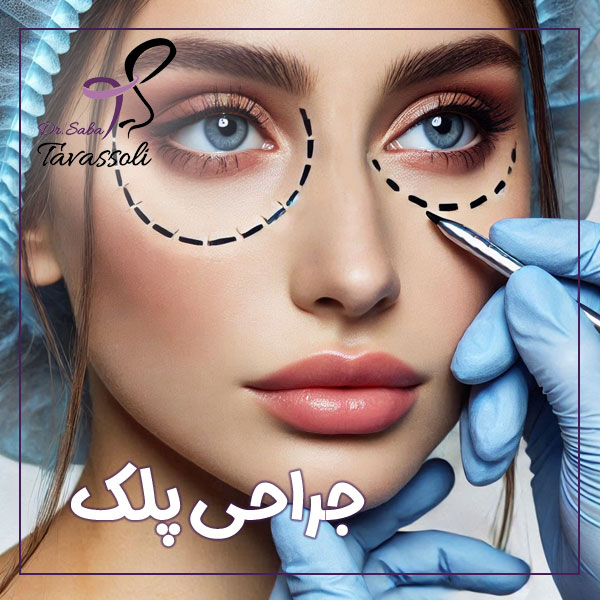جراحی پلک در بابل + دکتر صبا توسلی