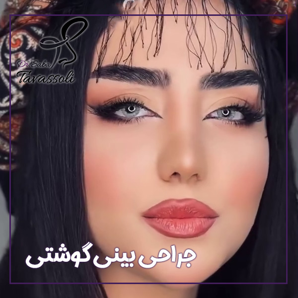 جراحی بینی گوشتی در بابل + دکتر صبا توسلی