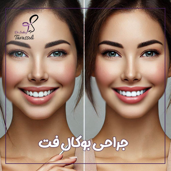 جراحی بوکال فت + دکتر صبا توسلی