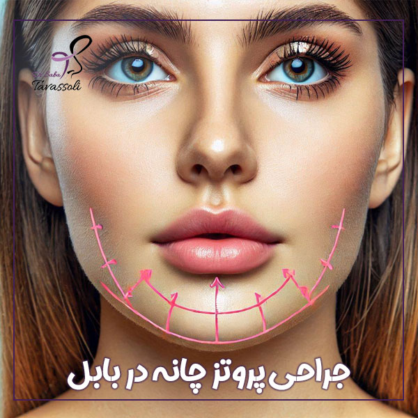 جراحی پروتز چانه در بابل + دکتر صبا توسلی