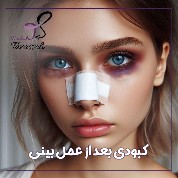 کبودی بعد از عمل بینی + دکتر صبا توسلی