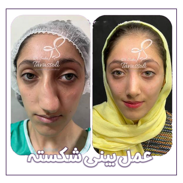 عمل بینی شکسته در بابل + دکتر صبا توسلی