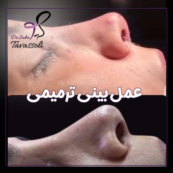 عمل بینی ترمیمی در بابل + دکتر صبا توسلی