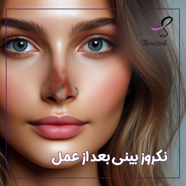 نکروز بینی بعد از عمل + دکتر صبا توسلی