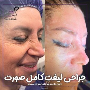 جراحی لیفت کامل صورت در بابل + دکتر توسلی