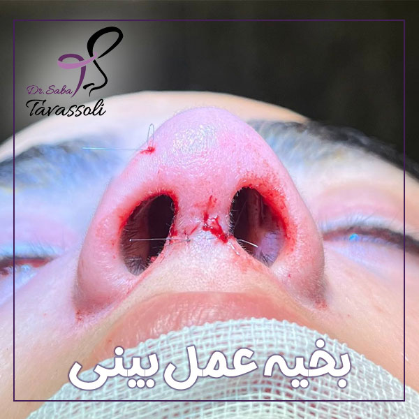 بخیه عمل بینی + دکتر صبا توسلی