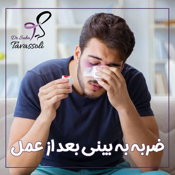 ضربه بینی بعد از عمل + دکتر صبا توسلی