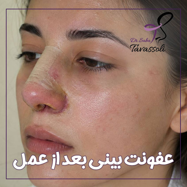 عفونت بعد از عمل بینی + دکتر صبا توسلی