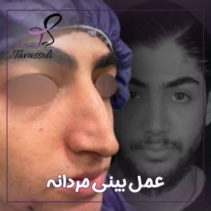عمل بینی مردانه در بابل + دکتر صبا توسلی
