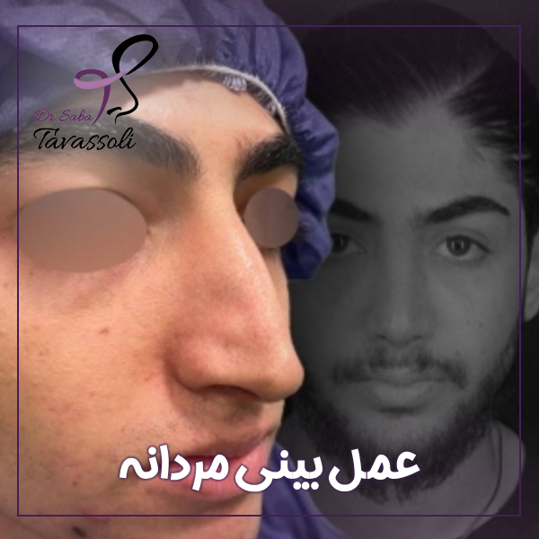 عمل بینی مردانه در بابل + دکتر صبا توسلی